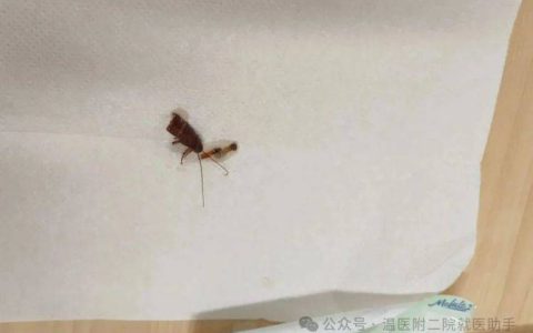 一女子耳鸣就医取出活蟑螂！这种习惯很多人都有