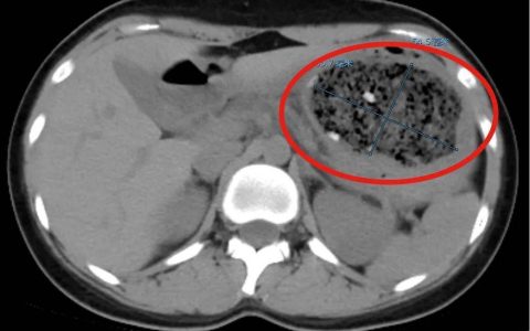 一口气吃了30多颗，“巨大异物”塞满整个胃