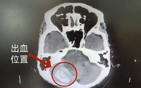 一场酒局引发脑出血，长期贪杯的代价有多可怕？