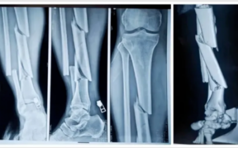 正骨紫金丸对创伤性骨折患者软组织修复及骨折愈合的影响