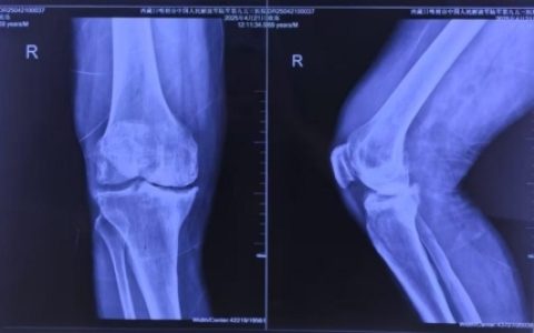 全国首例！西藏日喀则成功实施机器人辅助生物膝关节置换术
