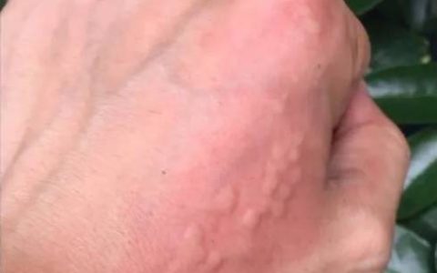 不要碰！上海有人已中招，刺痛灼烧感犹如被针扎并注入辣椒水