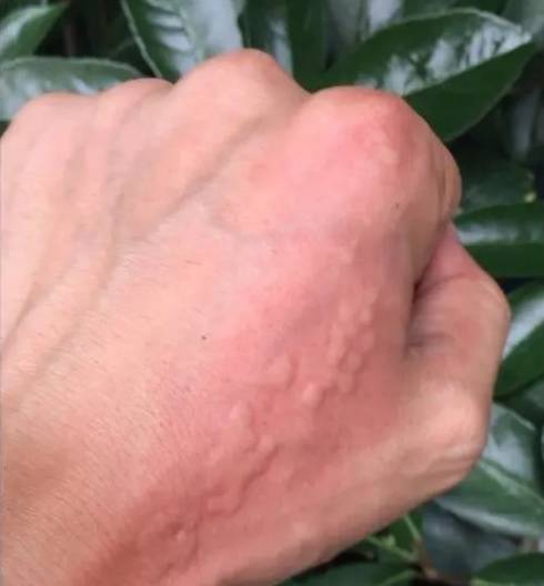 不要碰！上海有人已中招，刺痛灼烧感犹如被针扎并注入辣椒水插图