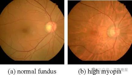 知名女演员自曝“近视700度”，需长期佩戴隐形眼镜！重要提醒：近视别超过这个度数，严重可致失明插图4