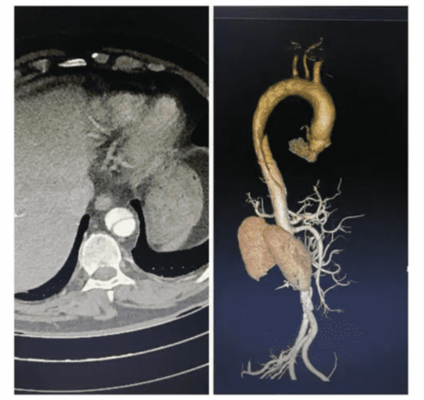 全球首款！浙大一院、阿里发布主动脉急诊AI模型：准确率高达99.4％插图