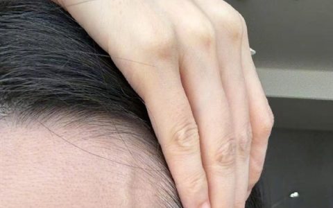 张靓颖自曝体检查出营养不良：额头血管莫名突起 伸懒腰手掌就流血