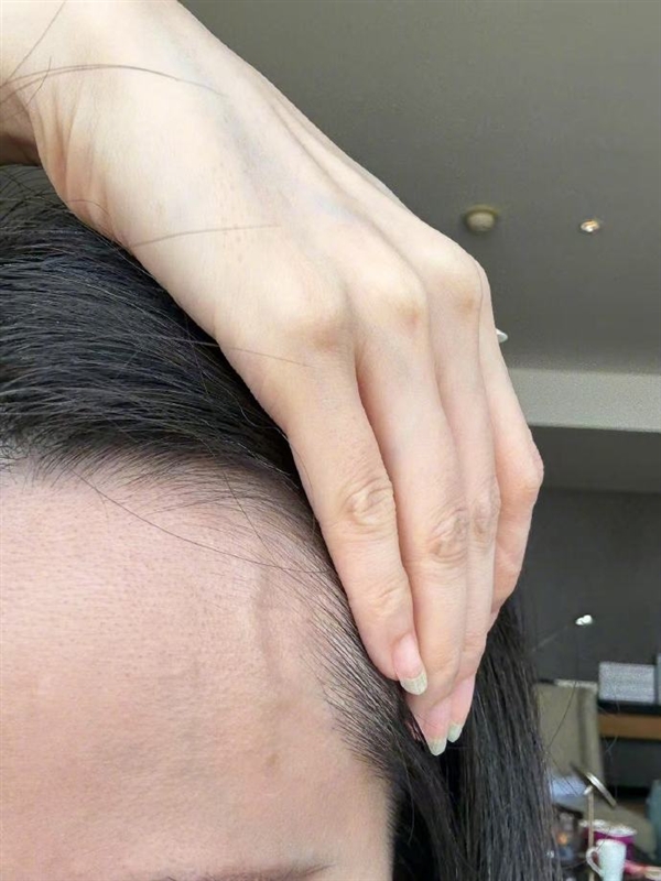 张靓颖自曝体检查出营养不良：额头血管莫名突起 伸懒腰手掌就流血插图