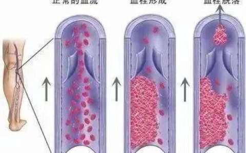 险些截肢，接连十余人确诊！这个习惯很多人都有