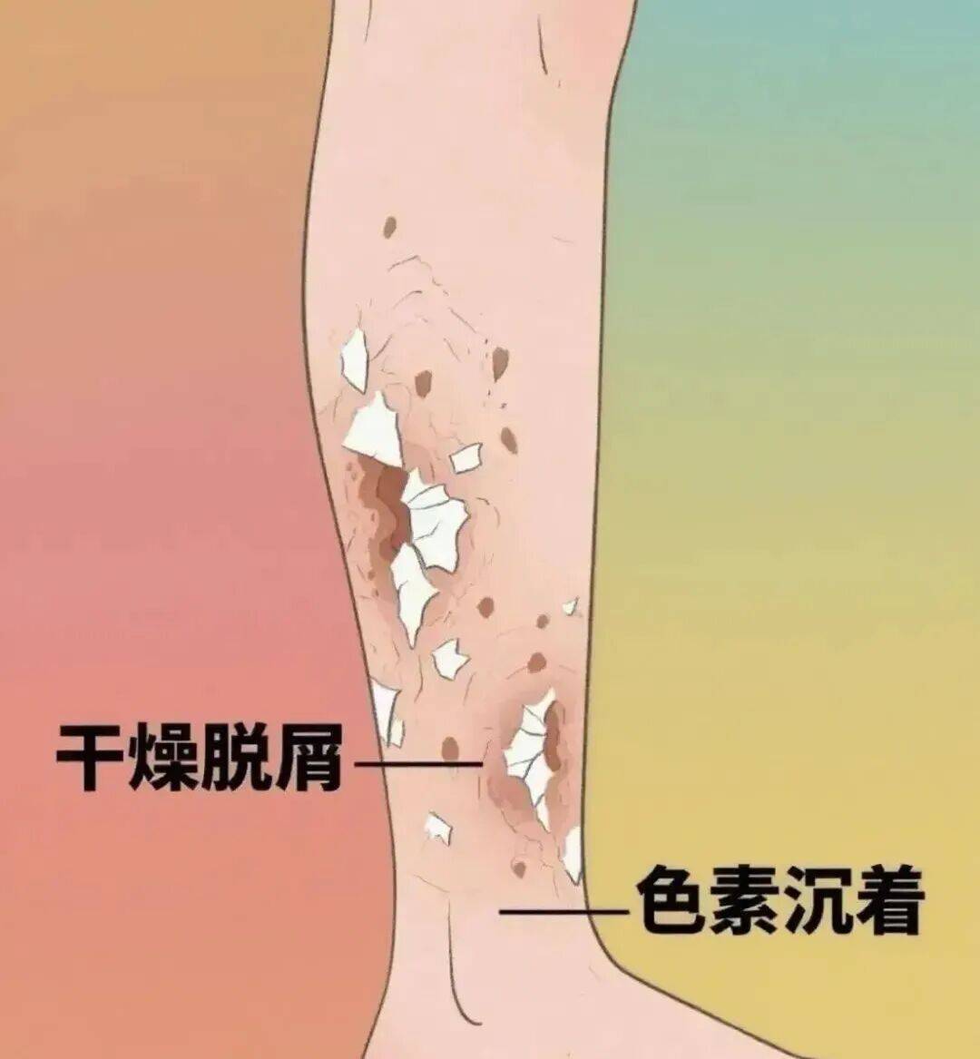 身体发出这3个信号，可能是血糖在“报警”，一定要当心！插图