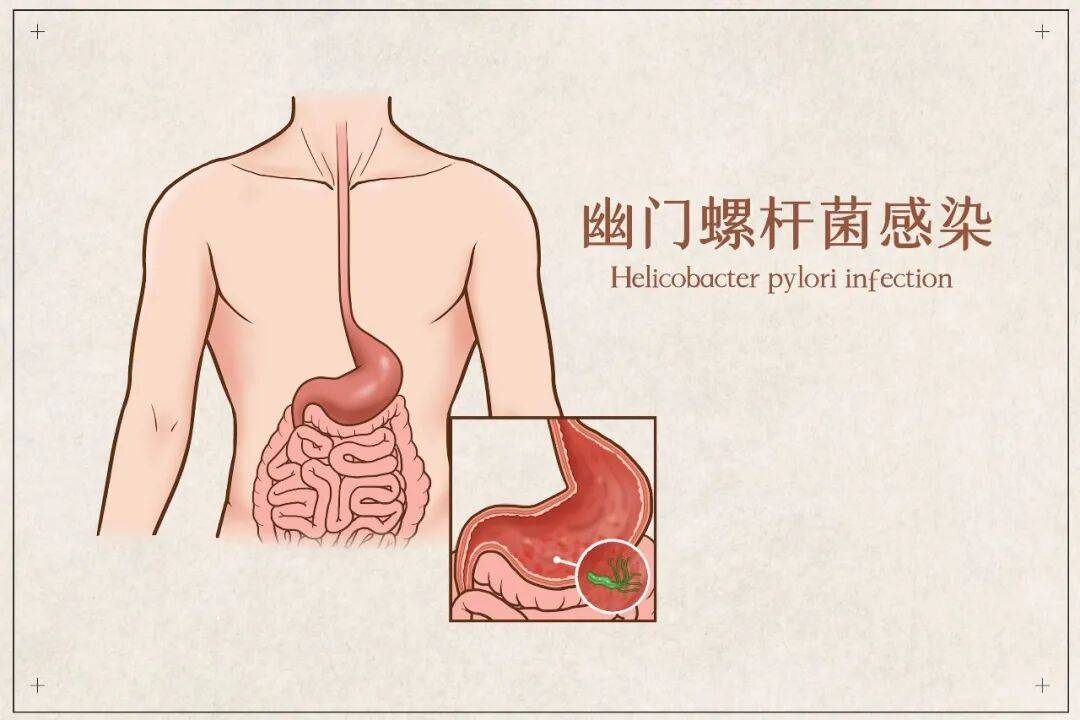 孩子感染幽门螺杆菌，要不要治？插图