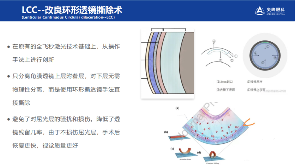 郑州LCC全飞秒创新上线！尖峰眼科专业插图2