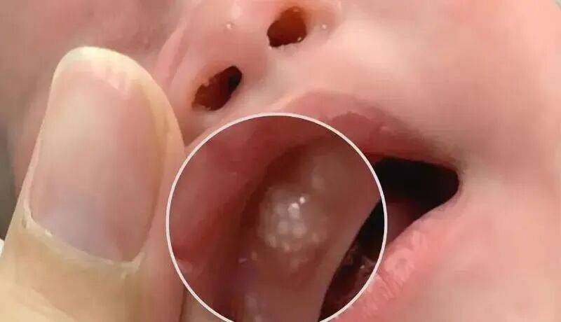 2个月婴儿因奶奶擦碘伏高烧进ICU， 医生提醒