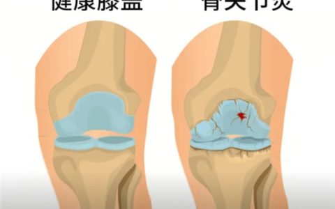 骨关节炎选药指南：理清盐酸和硫酸氨基酸葡萄糖胶囊的作用与功效