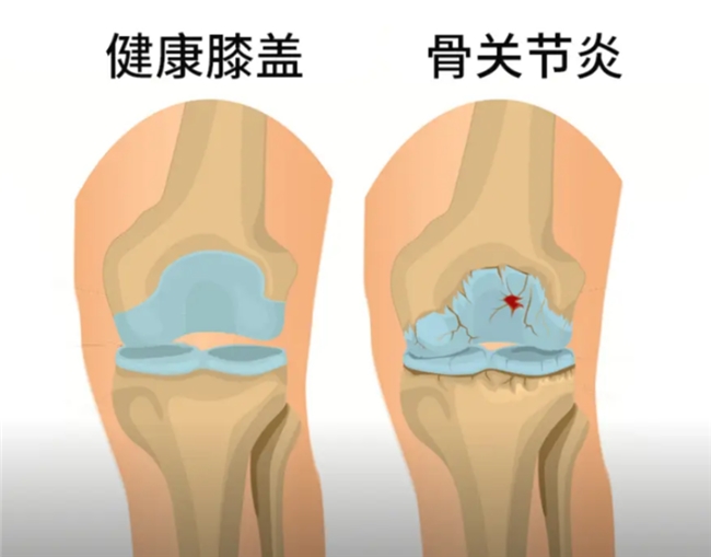 骨关节炎选药指南:理清盐酸和硫酸氨基酸葡萄糖胶囊的作用与功效插图 骨关节炎选药指南:理清盐酸和硫酸氨基酸葡萄糖胶囊的作用与功效插图
