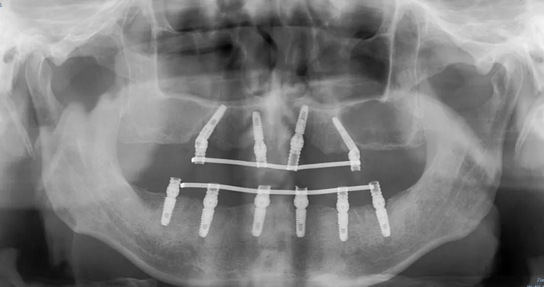 “不想拔最后一颗牙！”海南老人来沪实现半口牙“重生”插图1