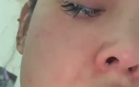 女子误将502喷入眼中睫毛全被拔 就医后保住视力