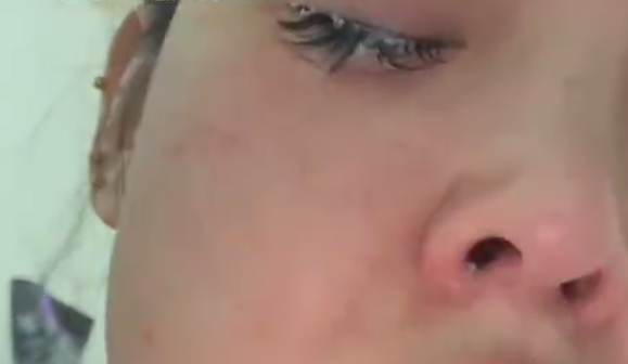 女子误将502喷入眼中睫毛全被拔 就医后保住视力插图