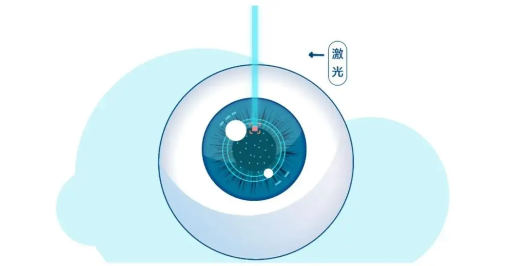 郑州ICL 晶体植入术优势，近视度数高怎么办，尖峰眼科插图1