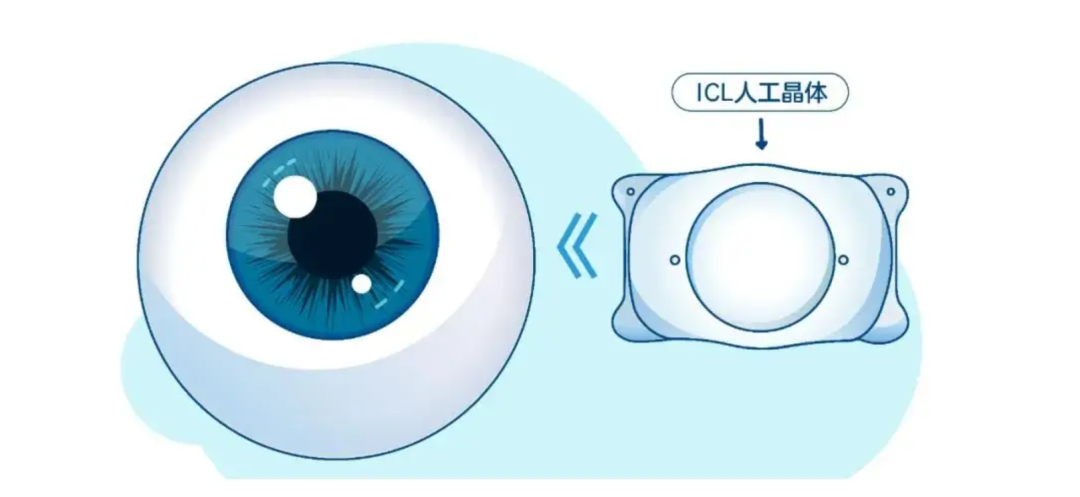 郑州ICL 晶体植入术优势，近视度数高怎么办，尖峰眼科插图2