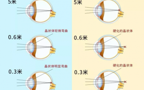 近视+老花两头烦？43岁妈妈用一次手术同时解决”