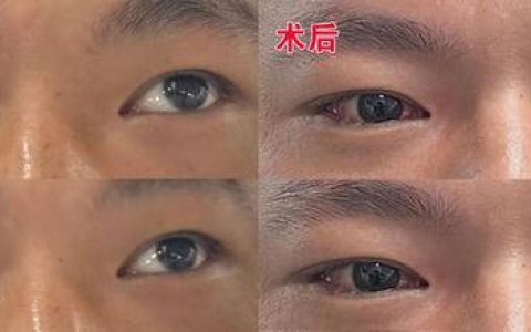 送餐途中一次偶遇，20年斜视问题迎来转机